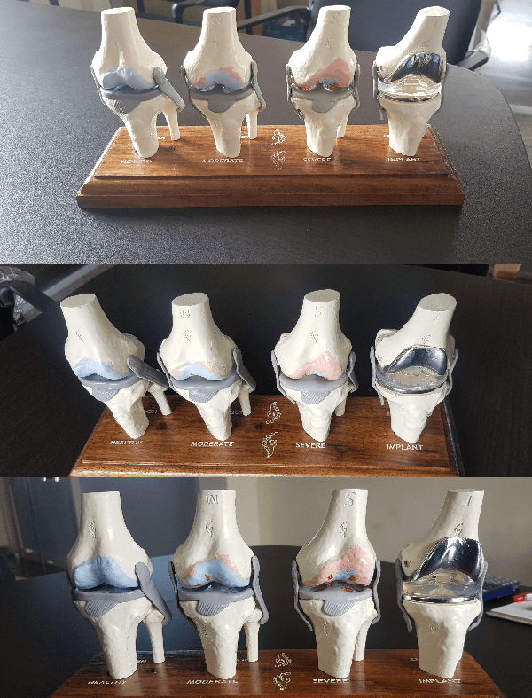 Knee Joint Medical Models